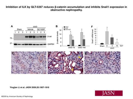 Inhibition of ILK by QLT-0267 reduces β-catenin accumulation and inhibits Snail1 expression in obstructive nephropathy. Inhibition of ILK by QLT-0267 reduces.