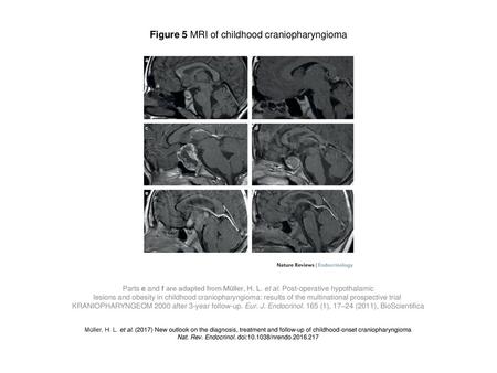 Figure 5 MRI of childhood craniopharyngioma