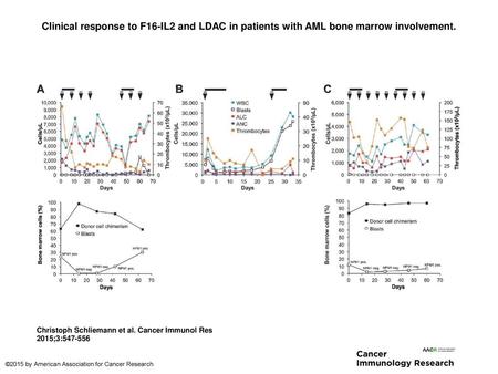 Clinical response to F16-IL2 and LDAC in patients with AML bone marrow involvement. Clinical response to F16-IL2 and LDAC in patients with AML bone marrow.