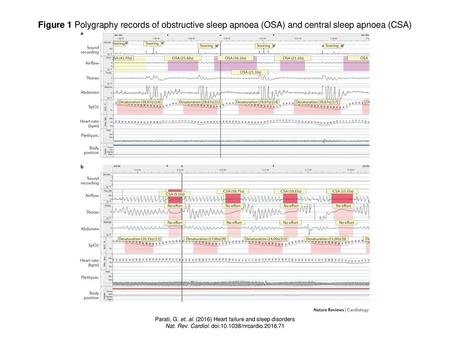 Figure 1 Polygraphy records of obstructive sleep apnoea (OSA) and central sleep apnoea (CSA) Figure 1 | Polygraphy records of obstructive sleep apnoea.