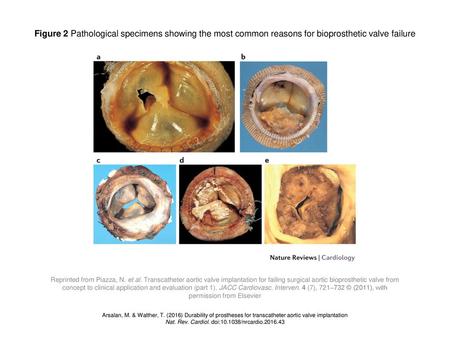 Figure 2 Pathological specimens showing the most common reasons for bioprosthetic valve failure Figure 2 | Pathological specimens showing the most common.