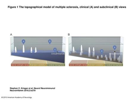 Figure 1 The topographical model of multiple sclerosis, clinical (A) and subclinical (B) views The topographical model of multiple sclerosis, clinical.