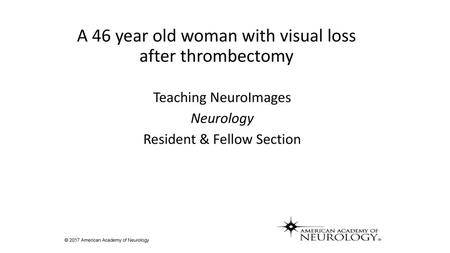 A 46 year old woman with visual loss after thrombectomy