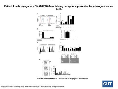Patient T cells recognise a SMAD4V370A-containing neoepitope presented by autologous cancer cells. Patient T cells recognise a SMAD4V370A-containing neoepitope.