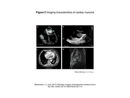 Figure 3 Imaging characteristics of cardiac myxoma