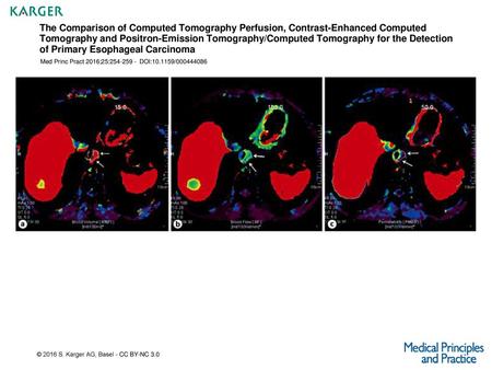 The Comparison of Computed Tomography Perfusion, Contrast-Enhanced Computed Tomography and Positron-Emission Tomography/Computed Tomography for the Detection.