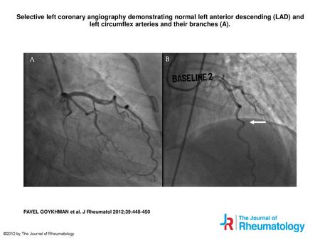 Selective left coronary angiography demonstrating normal left anterior descending (LAD) and left circumflex arteries and their branches (A). Selective.