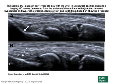 Mid-sagittal US images in an 11-year-old boy with the wrist in (A) neutral position showing a bulging MC recess (measured from the surface of the capitate.
