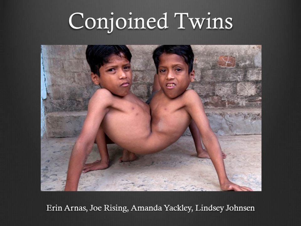 Conjoined Twins Abby And Brittany Hensel Are Now Thriving 30 Years Later