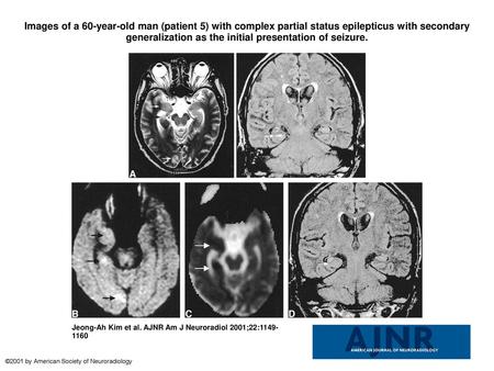 Images of a 60-year-old man (patient 5) with complex partial status epilepticus with secondary generalization as the initial presentation of seizure. Images.