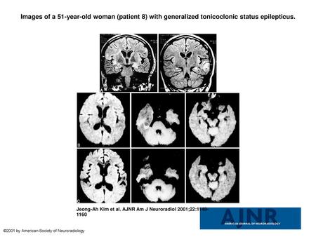 Images of a 51-year-old woman (patient 8) with generalized tonicoclonic status epilepticus. Images of a 51-year-old woman (patient 8) with generalized.