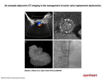 An example adjunctive CT imaging in the management of aortic valve replacement dysfunction. An example adjunctive CT imaging in the management of aortic.