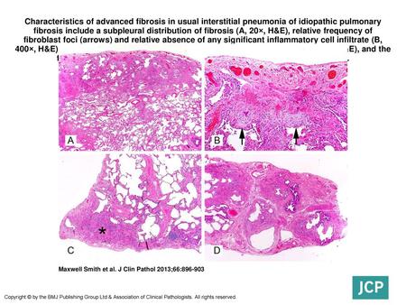 Characteristics of advanced fibrosis in usual interstitial pneumonia of idiopathic pulmonary fibrosis include a subpleural distribution of fibrosis (A,