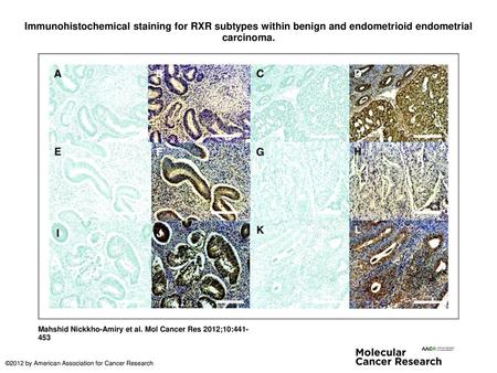 Immunohistochemical staining for RXR subtypes within benign and endometrioid endometrial carcinoma. Immunohistochemical staining for RXR subtypes within.