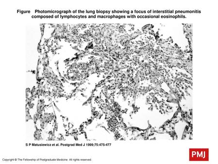Figure Photomicrograph of the lung biopsy showing a focus of interstitial pneumonitis composed of lymphocytes and macrophages with occasional eosinophils.