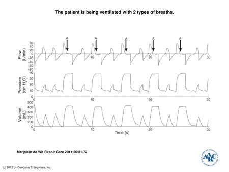 The patient is being ventilated with 2 types of breaths.