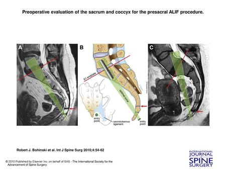 Preoperative evaluation of the sacrum and coccyx for the presacral ALIF procedure. Preoperative evaluation of the sacrum and coccyx for the presacral ALIF.