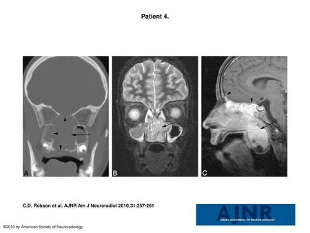 Patient 4. Patient 4. Sinonasal carcinoma t(15;19). A, CT scan demonstrates a midline sinonasal tumor (arrow) with lytic bony destruction of the paranasal.
