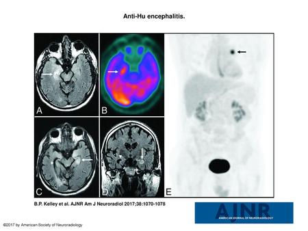 Anti-Hu encephalitis. Anti-Hu encephalitis. A 68-year-old man with chronic obstructive pulmonary disease presented with gradually worsening memory deficits.