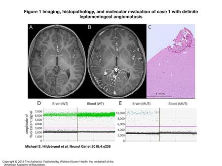 Figure 1 Imaging, histopathology, and molecular evaluation of case 1 with definite leptomeningeal angiomatosis Imaging, histopathology, and molecular evaluation.