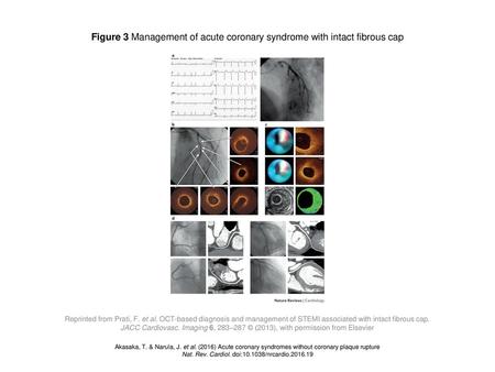 Figure 3 Management of acute coronary syndrome with intact fibrous cap