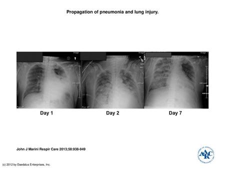 Propagation of pneumonia and lung injury.
