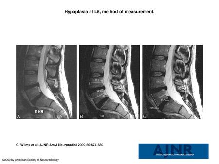 Hypoplasia at L5, method of measurement.