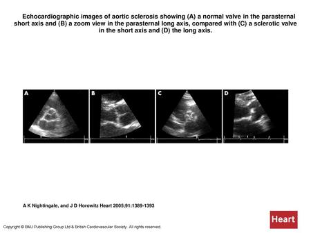  Echocardiographic images of aortic sclerosis showing (A) a normal valve in the parasternal short axis and (B) a zoom view in the parasternal long axis,