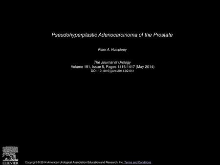 Pseudohyperplastic Adenocarcinoma of the Prostate