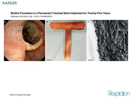 Biofilm Formation in a Permanent Tracheal Stent Implanted for Twenty-Five Years Respiration 2015;90:327-328 - DOI:10.1159/000439312 Fig. 1.a Endoscopic.