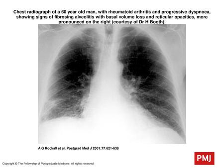 Chest radiograph of a 60 year old man, with rheumatoid arthritis and progressive dyspnoea, showing signs of fibrosing alveolitis with basal volume loss.