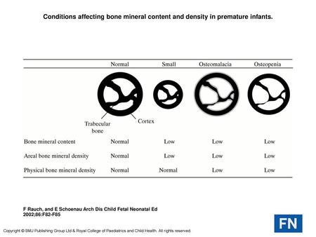 Conditions affecting bone mineral content and density in premature infants. Conditions affecting bone mineral content and density in premature infants.