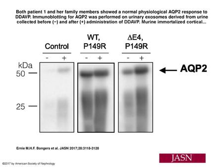 Both patient 1 and her family members showed a normal physiological AQP2 response to DDAVP. Immunoblotting for AQP2 was performed on urinary exosomes derived.