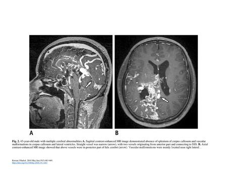 Fig year-old male with multiple cerebral abnormalities. A