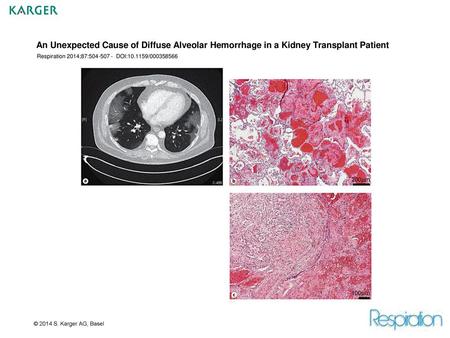 An Unexpected Cause of Diffuse Alveolar Hemorrhage in a Kidney Transplant Patient Respiration 2014;87:504-507 - DOI:10.1159/000358566 Fig. 1.a Chest CT.