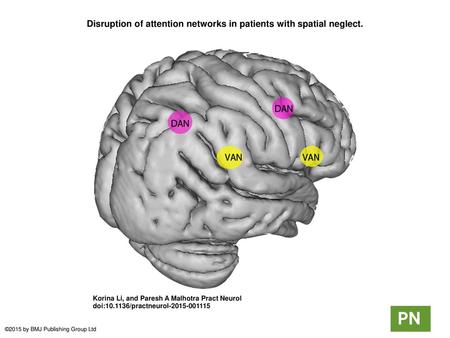 Disruption of attention networks in patients with spatial neglect.