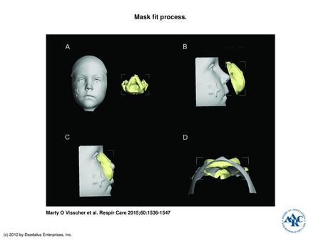 Mask fit process. Mask fit process. The mask fit process begins with 3-dimensional surface images of the subject's face (A). Three-dimensional scans are.
