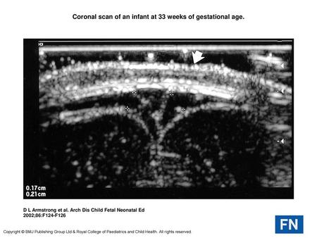 Coronal scan of an infant at 33 weeks of gestational age.