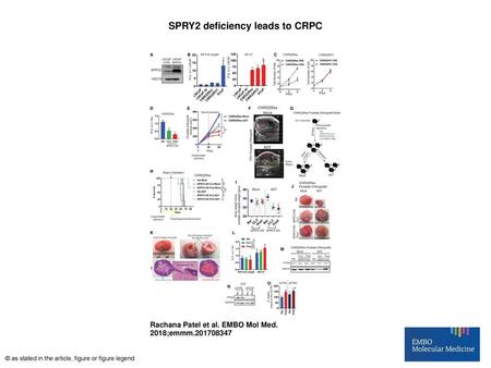 SPRY2 deficiency leads to CRPC