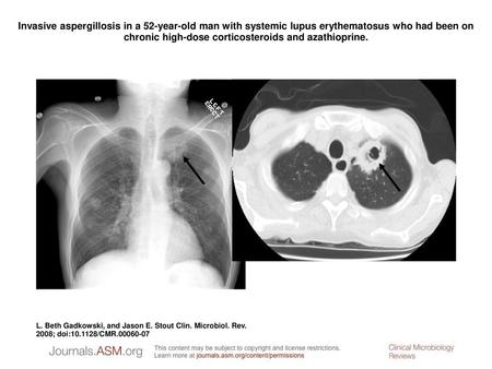 Invasive aspergillosis in a 52-year-old man with systemic lupus erythematosus who had been on chronic high-dose corticosteroids and azathioprine. Invasive.