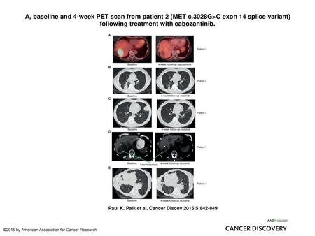 A, baseline and 4-week PET scan from patient 2 (MET c