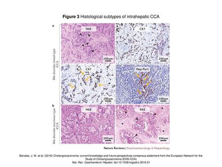 Figure 3 Histological subtypes of intrahepatic CCA