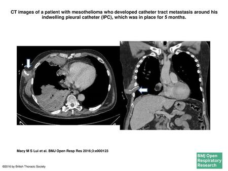 CT images of a patient with mesothelioma who developed catheter tract metastasis around his indwelling pleural catheter (IPC), which was in place for 5 months.