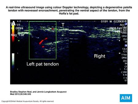 A real-time ultrasound image using colour Doppler technology, depicting a degenerative patella tendon with neovessel encroachment, penetrating the ventral.