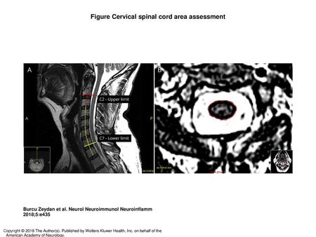 Figure Cervical spinal cord area assessment