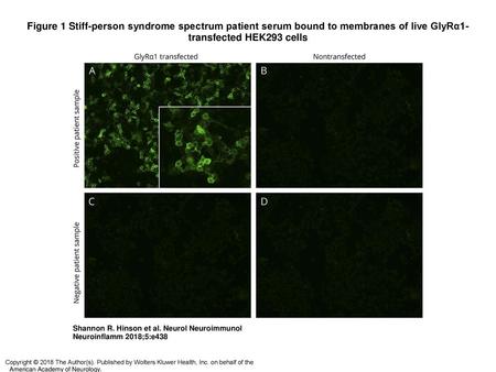 Figure 1 Stiff-person syndrome spectrum patient serum bound to membranes of live GlyRα1-transfected HEK293 cells Stiff-person syndrome spectrum patient.