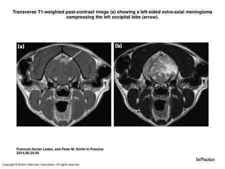Transverse T1-weighted post-contrast image (a) showing a left-sided extra-axial meningioma compressing the left occipital lobe (arrow). Transverse T1-weighted.