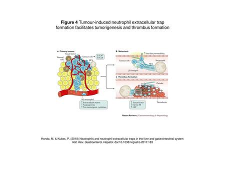 Figure 4 Tumour-induced neutrophil extracellular trap