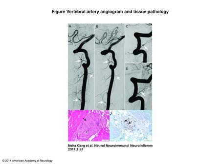 Figure Vertebral artery angiogram and tissue pathology