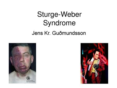 Sturge-Weber Syndrome
